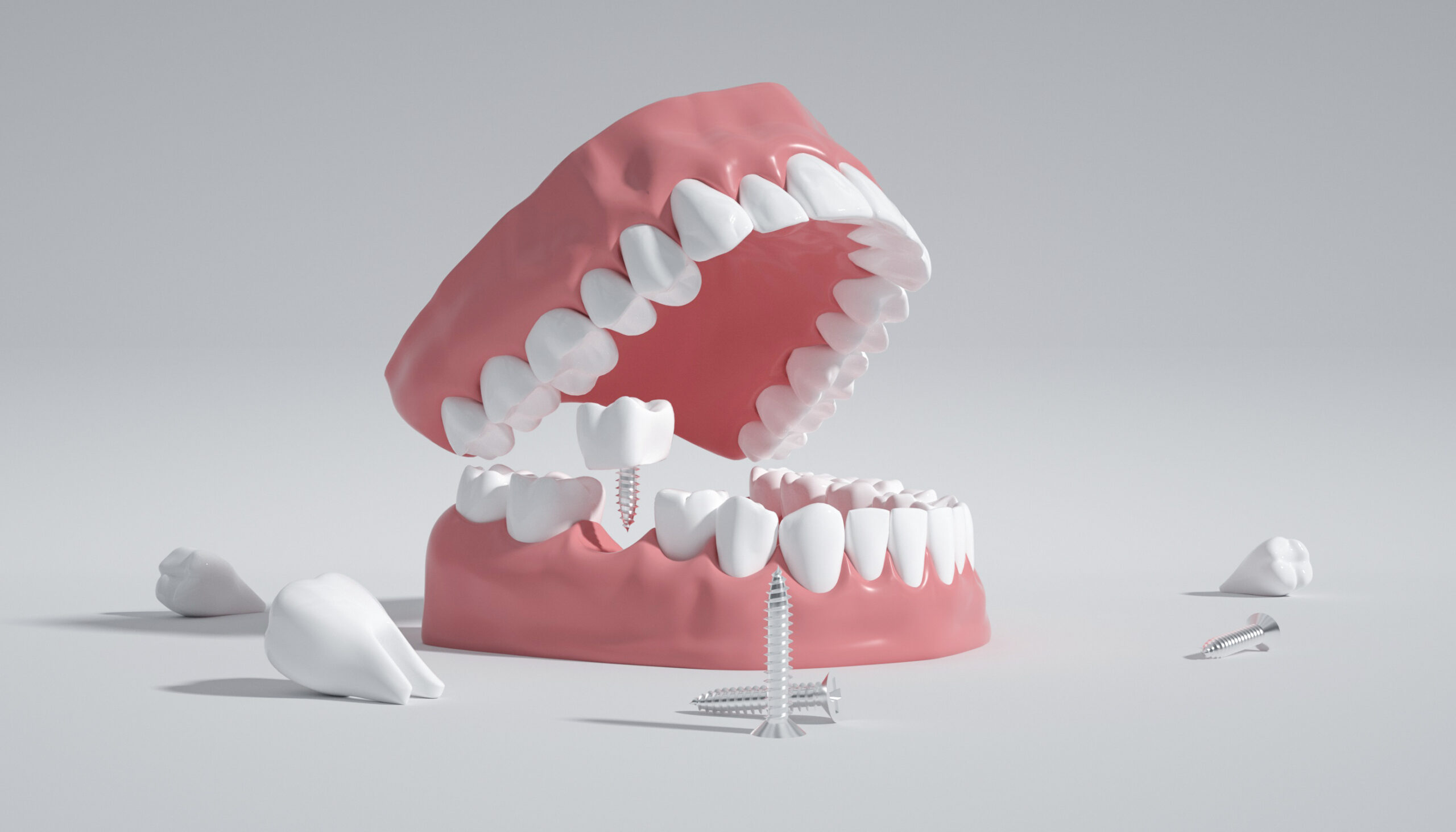 Why should young people with missing teeth get implants as soon as possible?