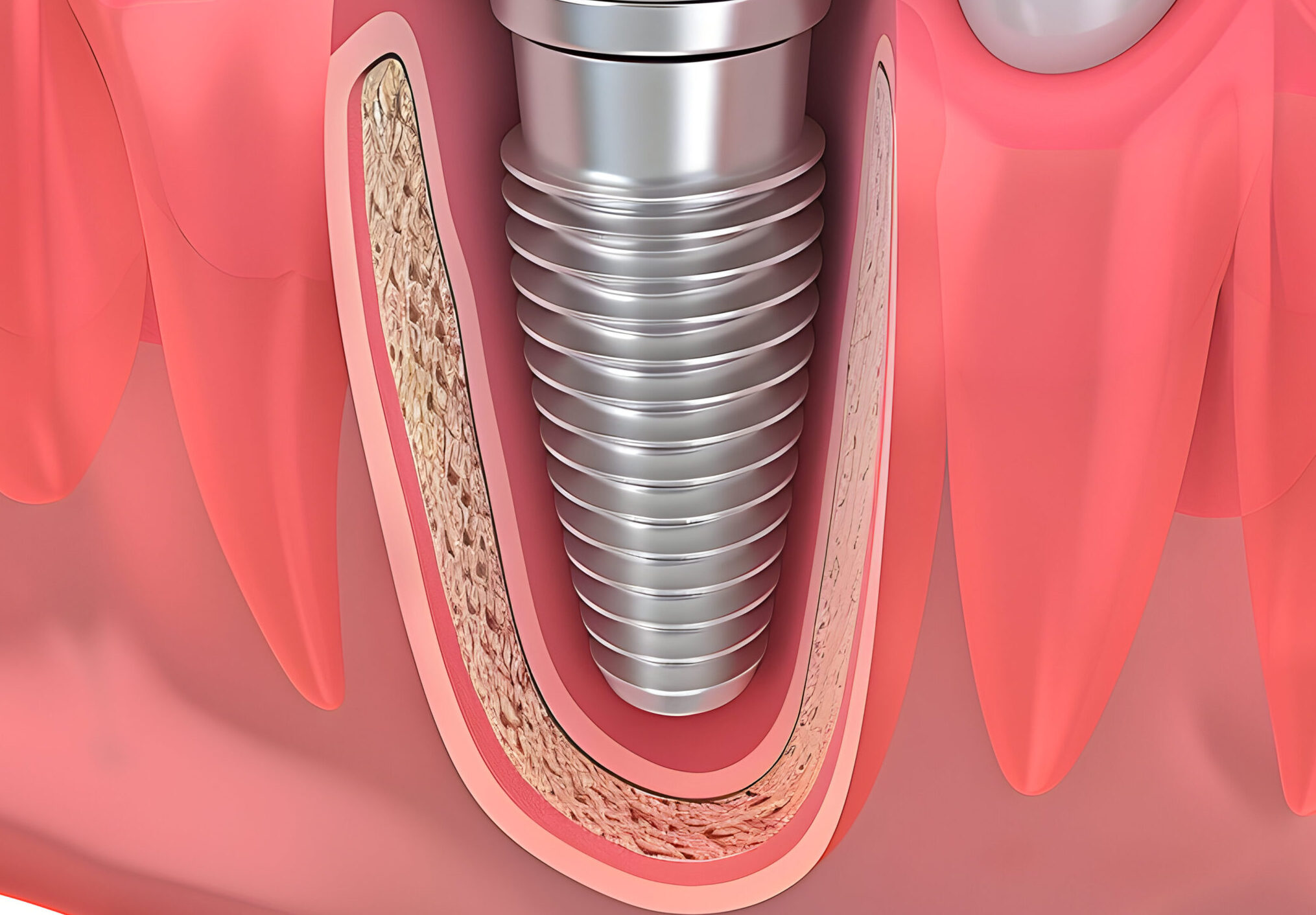 Beyond Dentures: Why Many Are Opting for Dental Implants