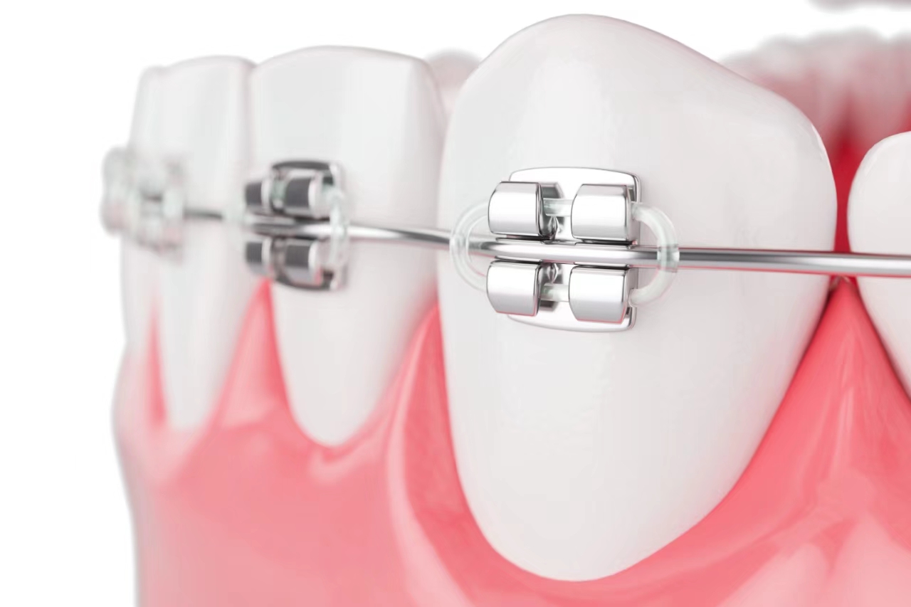 Achieving a Perfect Smile: The Role of Orthodontics